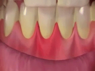 teeth sensitivity