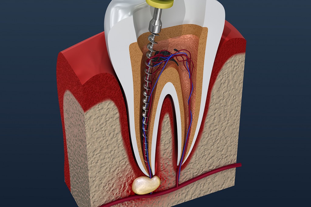root canal treatment.png